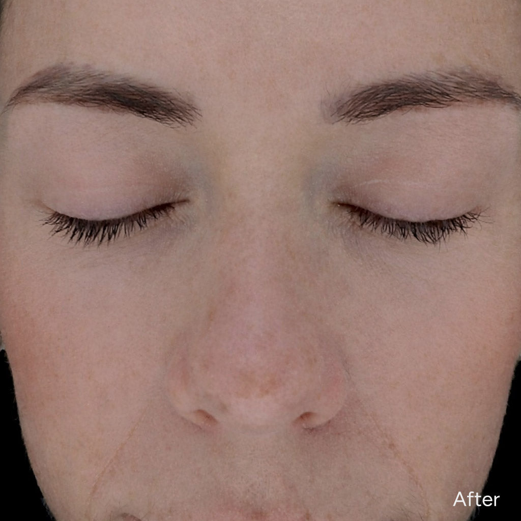 Close-up of a person's face with closed eyes, showing 'After' in the corner.